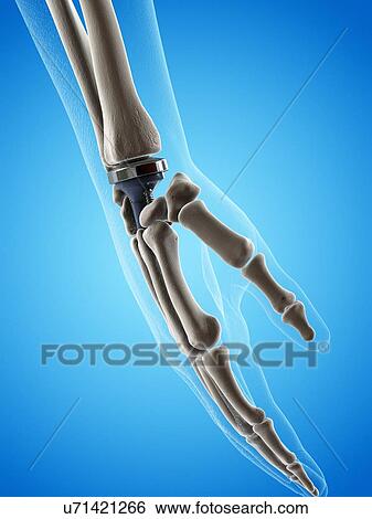 Stock Photograph - Illustration of a wrist replacement. Fotosearch
