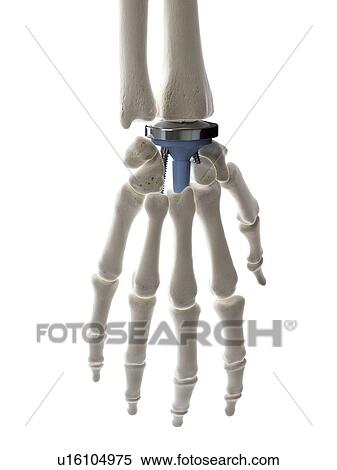 Stock Photography - Illustration of a wrist replacement. Fotosearch