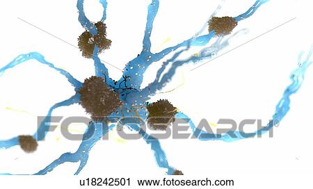 Illustration of Alzheimer's disease View Large Photo Image Stock Image - Illustration of Alzheimer's disease. Fotosearch