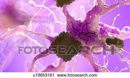 Stock Image - Illustration of Alzheimer's disease. Fotosearch