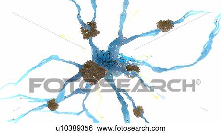 Stock Photograph - Illustration of Alzheimer's disease. Fotosearch