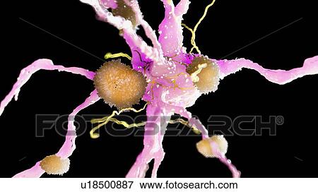 Stock Photo - Illustration of amyloid plaques on a nerve cell. Fotosearch
