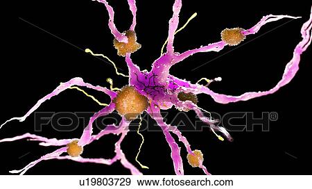Stock Photo - Illustration of amyloid plaques on a nerve cell. Fotosearch