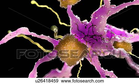 Illustration of amyloid plaques on a nerve cell View Large Photo Image Stock Photo - Illustration of amyloid plaques on a nerve cell. Fotosearch