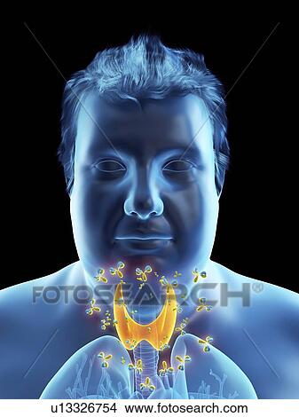 Picture - Illustration of an autoimmune thyroid disease. Fotosearch