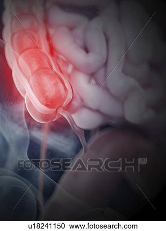 Stock Image - Illustration of an inflamed colon. Fotosearch