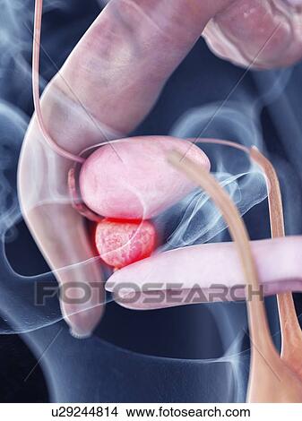 Illustration of an inflamed pancreas View Large Photo Image Picture - Illustration of an inflamed pancreas. Fotosearch