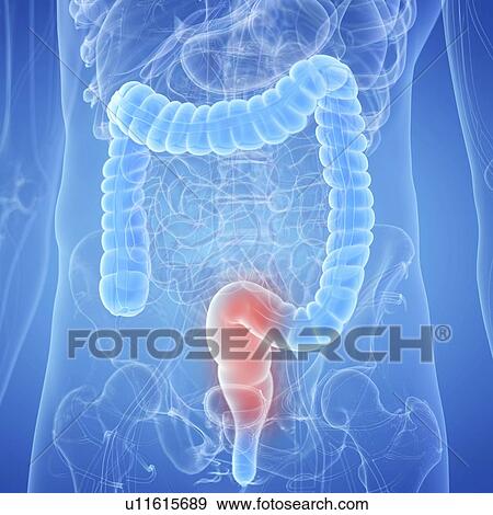Illustration of an inflamed rectum View Large Photo Image Stock Photo - Illustration of an inflamed rectum. Fotosearch
