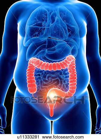 Stock Image - Illustration of an obese man with a painful colon. Fotosearch