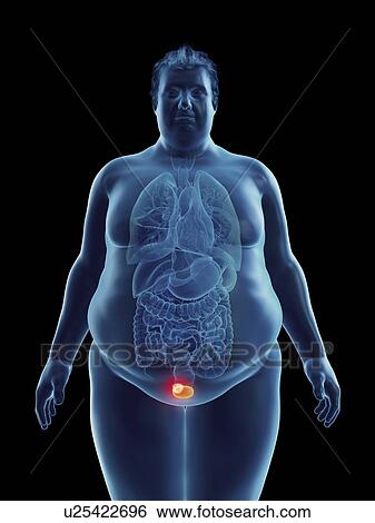 Illustration of an obese man's bladder tumor View Large Photo Image Stock Photograph - Illustration of an obese man's bladder tumor. Fotosearch