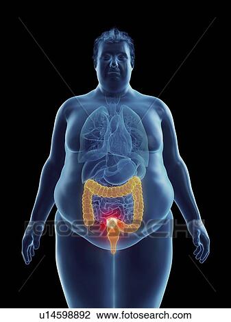 Stock Image - Illustration of an obese man's colon tumor. Fotosearch