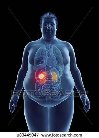 Stock Photo - Illustration of an obese man's kidney tumor. Fotosearch