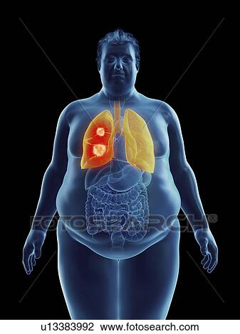 Illustration of an obese man's lung tumor View Large Photo Image Stock Image - Illustration of an obese man's lung tumor. Fotosearch