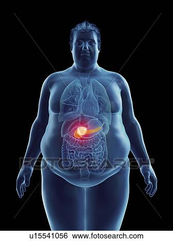 Stock Photograph - Illustration of an obese man's pancreas tumor. Fotosearch