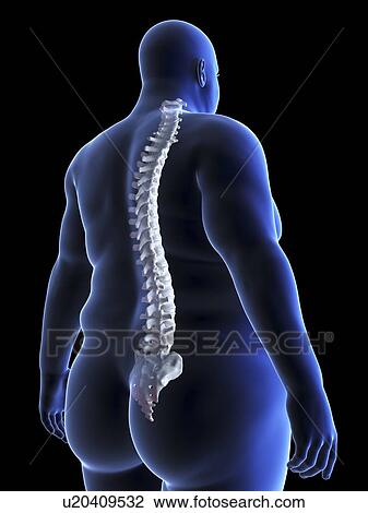 Stock Image - Illustration of an obese man's spine. Fotosearch