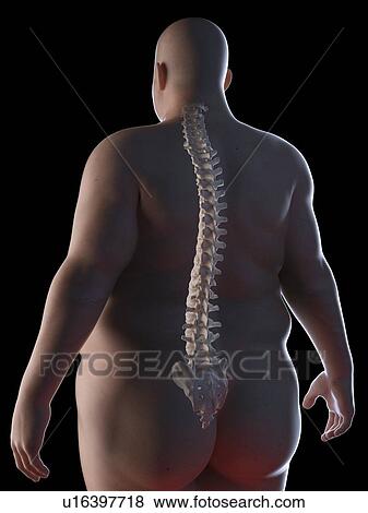 Stock Photo - Illustration of an obese man's spine. Fotosearch