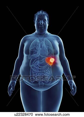 Stock Image - Illustration of an obese man's spleen tumor. Fotosearch
