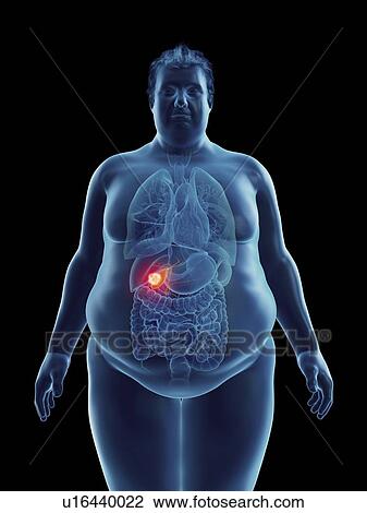 Illustration of an obese man's gallbladder tumor View Large Photo Image Stock Image - Illustration of an obese man's gallbladder tumor. Fotosearch
