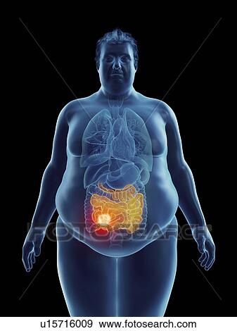 Illustration of an obese man's intestine tumor View Large Photo Image Stock Photo - Illustration of an obese man's intestine tumor. Fotosearch