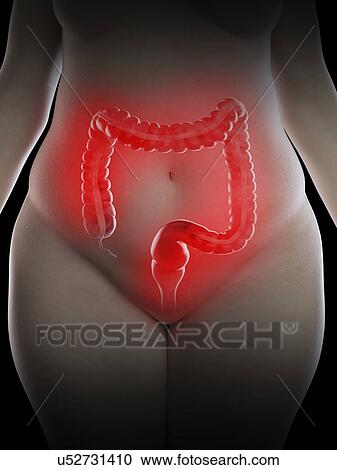 Illustration of an obese woman's inflamed colon View Large Photo Image Stock Image - Illustration of an obese woman's inflamed colon. Fotosearch