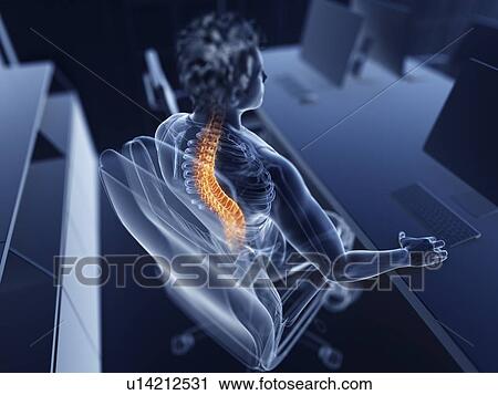 Stock Image - Illustration of an office worker with a painful back. Fotosearch