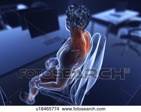 Picture - Illustration of an office worker's painful muscles. Fotosearch