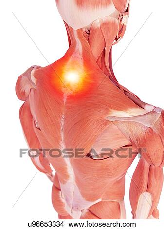 Picture - Illustration of back muscle pain. Fotosearch