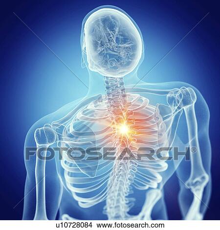 Picture - Illustration of backache. Fotosearch