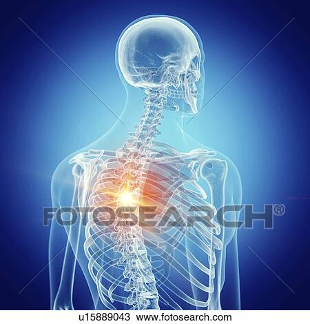 Illustration of backache View Large Photo Image Stock Image - Illustration of backache. Fotosearch