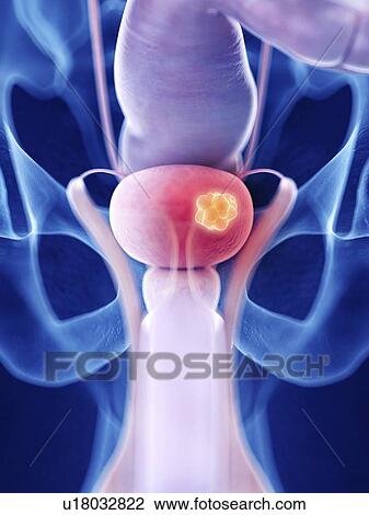 Stock Image - Illustration of bladder cancer. Fotosearch