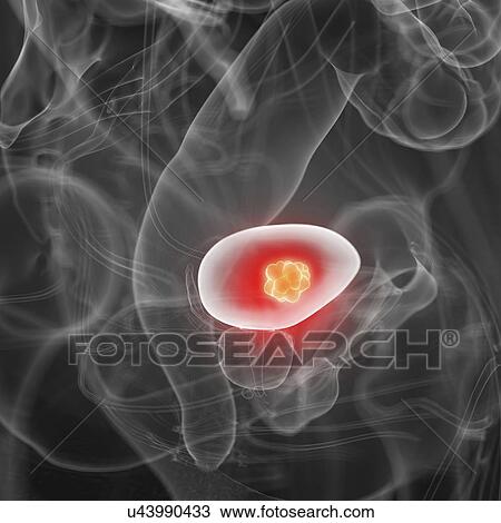 Illustration of bladder cancer View Large Photo Image Stock Image - Illustration of bladder cancer. Fotosearch
