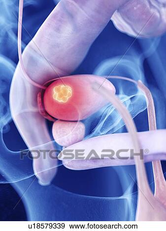 Stock Photo - Illustration of bladder cancer. Fotosearch