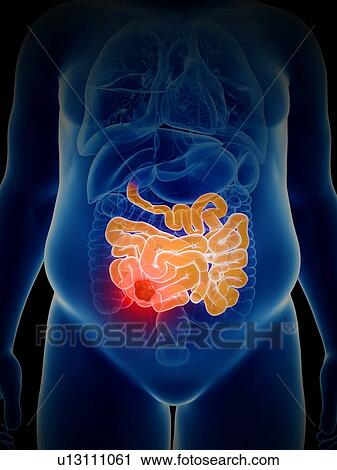 Illustration of bowel cancer View Large Photo Image Stock Image - Illustration of bowel cancer. Fotosearch
