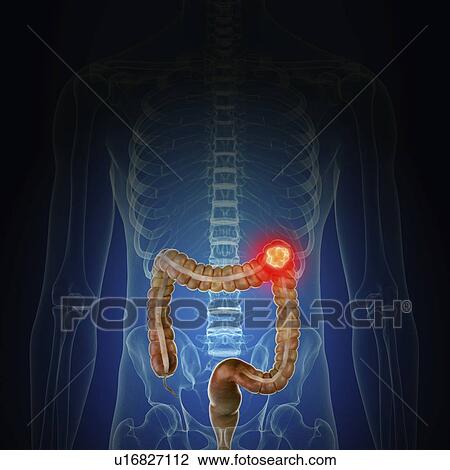 Stock Image - Illustration of colon cancer. Fotosearch
