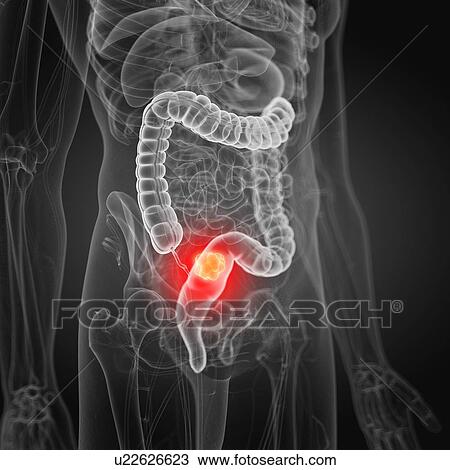 Stock Image - Illustration of colon cancer. Fotosearch