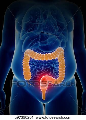 Stock Image - Illustration of colon cancer. Fotosearch