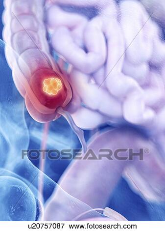 Stock Photo - Illustration of colon cancer. Fotosearch