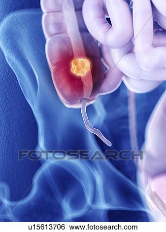 Stock Photograph - Illustration of colon cancer. Fotosearch
