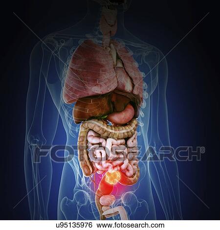 Stock Photograph - Illustration of colon cancer. Fotosearch