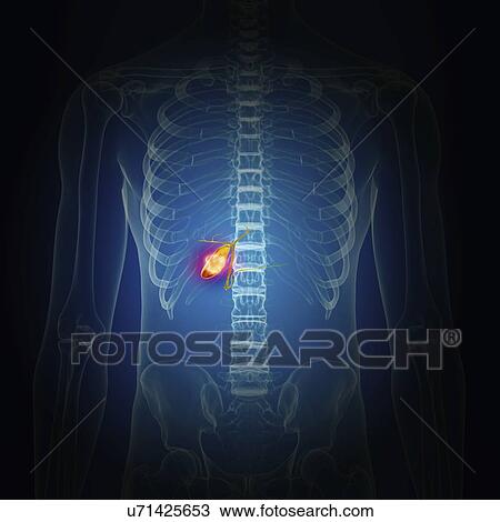Stock Image - Illustration of gallbladder cancer. Fotosearch