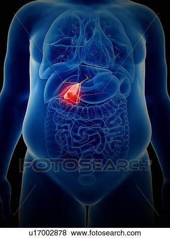 Stock Photo - Illustration of gallbladder cancer. Fotosearch