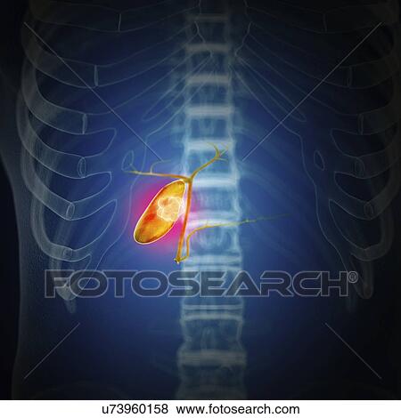 Stock Photo - Illustration of gallbladder cancer. Fotosearch