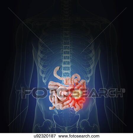 Stock Photo - Illustration of intestine cancer. Fotosearch