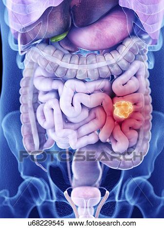 Stock Photography - Illustration of intestine cancer. Fotosearch
