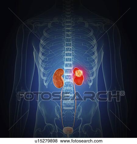 Stock Photo - Illustration of kidney cancer. Fotosearch