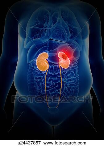 Stock Photo - Illustration of kidney cancer. Fotosearch