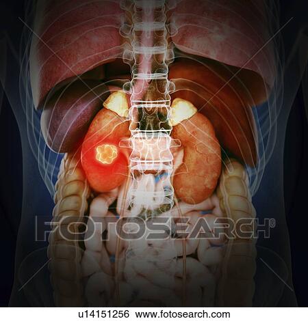 Stock Photograph - Illustration of kidney cancer. Fotosearch