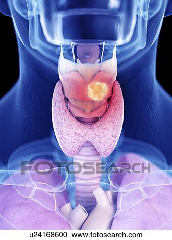 Stock Image - Illustration of larynx cancer. Fotosearch