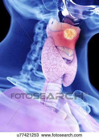 Stock Image - Illustration of larynx cancer. Fotosearch