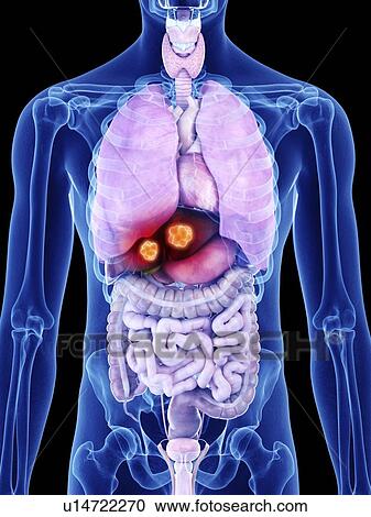 Illustration of liver cancer View Large Photo Image Stock Image - Illustration of liver cancer. Fotosearch
